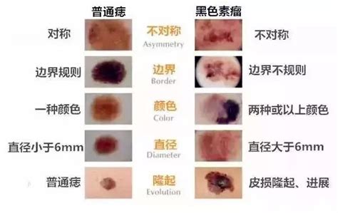 臉突然長痣|痣是什麼？會變成黑色素瘤？7種一定要除的痣